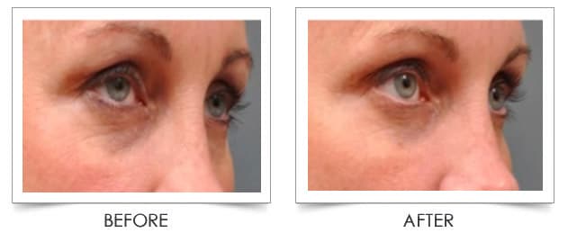 microneedling before eyes under skin laser procedures columbia center