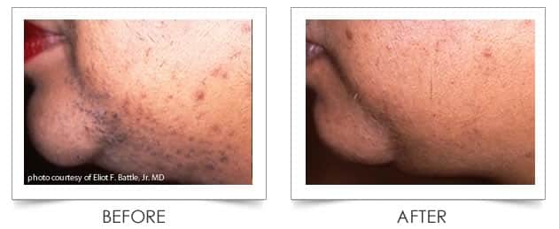 Laser Hair Reduction at Columbia Laser Skin Center in the Hood River and The Dalles Oregon area