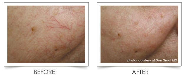 Laser Vein Treatment at Columbia Laser Skin Center - Before and After Cheeks
