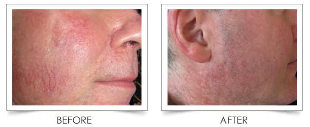 Laser Vein Treatment on the face