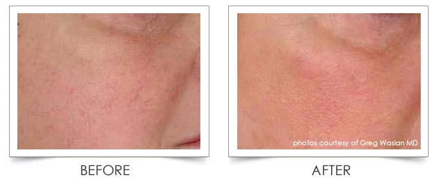 Laser Vein Treatment by Columbia Laser Skin Centdr