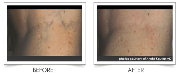 Laser Vein Treatment Results at Columbia Laser Skin Center - serving the Hood River, The Dalles and the surrounding areas