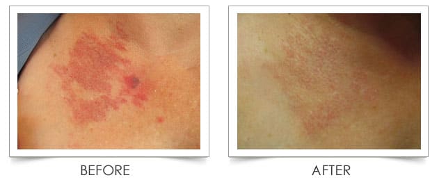 Laser Vein Before and After at Columbia Laser Skin Center - serving the Hood River, The Dalles and the surrounding areas