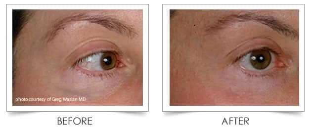 Laser Vein Treatment at Columbia Laser Skin Center - Before and After Under Eyes