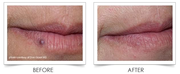 Laser Vein Treatment at Columbia Laser Skin Center - Before and After Mole on Lip