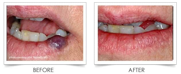 Laser Vein Treatment at Columbia Laser Skin Center - Before and After Lips
