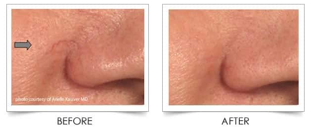 Laser Vein Treatment at Columbia Laser Skin Center - Before and After Nose and Cheeks