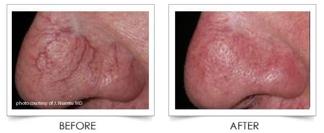 Laser Vein Treatment at Columbia Laser Skin Center - Before and After Nose