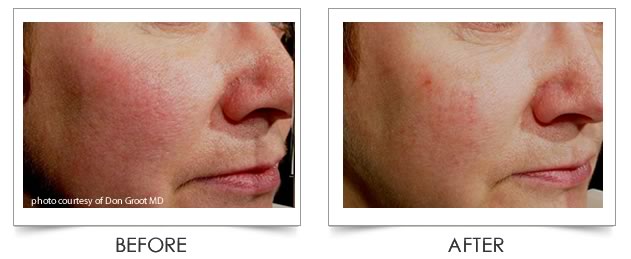Laser Vein Treatment at Columbia Laser Skin Center - Before and After Treatment