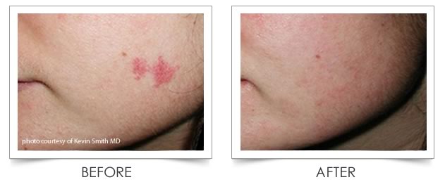 Laser Vein Treatment at Columbia Laser Skin Center - Before and After Scar