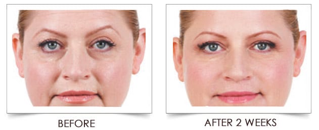 juvederm-voluma-4-before-after-columbia-laser-skin-center-hood-river-oregon-2016-treatments