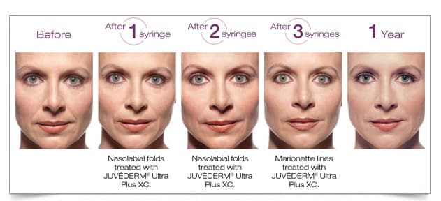 juvederm-voluma-7-before-after-columbia-laser-skin-center-hood-river-oregon-2016-treatments