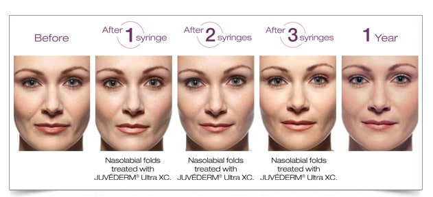 juvederm-voluma-8-before-after-columbia-laser-skin-center-hood-river-oregon-2016-treatments