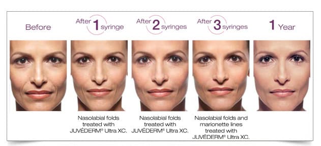 juvederm-voluma-9-before-after-columbia-laser-skin-center-hood-river-oregon-2016-treatments