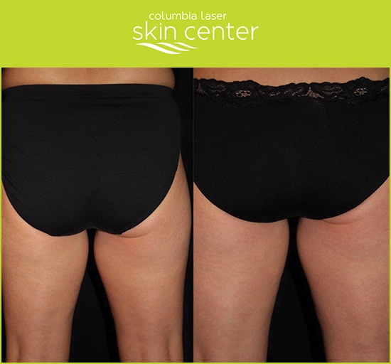 CoolSculpting butt - Before and After - available at Columbia Laser Skin Center - serving Hood River, The Dalles and surrounding areas in Oregon and Washington