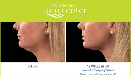 CoolSculpting Double Chin repair - available for Hood River, The Dalles and surrounding areas in Oregon and Washington at Columbia Laser Skin Center