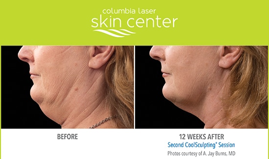CoolSculpting Double Chin repair - available for Hood River, The Dalles and surrounding areas in Oregon and Washington at Columbia Laser Skin Center