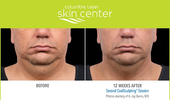 CoolSculpting Neck Repair - available for Hood River, The Dalles and surrounding areas in Oregon and Washington at Columbia Laser Skin Center