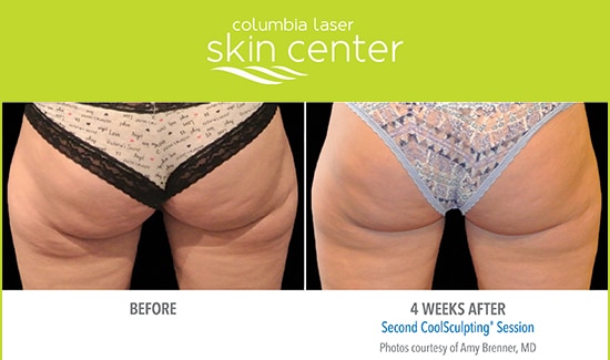 CoolSculpting Before and After - available at Columbia Laser Skin Center - serving Hood River, The Dalles and surrounding areas in Oregon and Washington