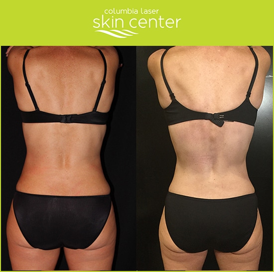 CoolSculpting Love Handles Repair - available for Hood River, The Dalles and surrounding areas in Oregon and Washington at Columbia Laser Skin Center
