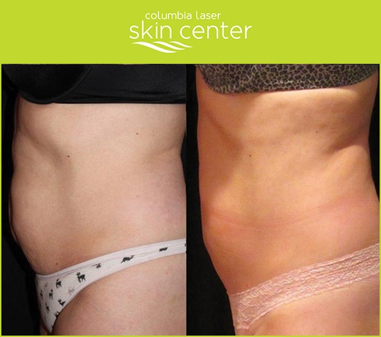 CoolSculpting Tummy before and after - available for Hood River, The Dalles and surrounding areas in Oregon and Washington at Columbia Laser Skin Center