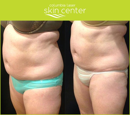 CoolSculpting Tummy before and after - available for Hood River, The Dalles and surrounding areas in Oregon and Washington at Columbia Laser Skin Center
