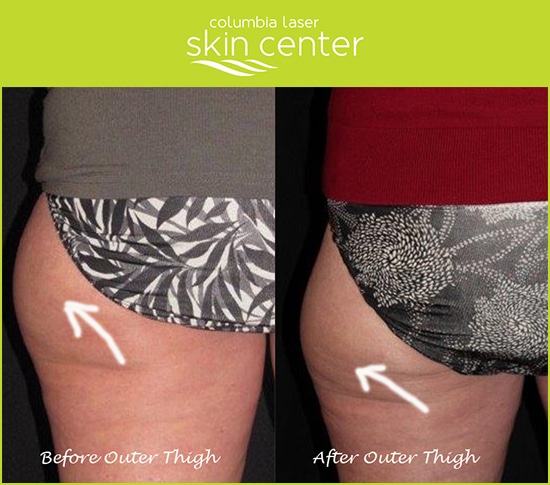 CoolSculpting Butt Fix Before and After - available at Columbia Laser Skin Center - serving Hood River, The Dalles and surrounding areas in Oregon and Washington