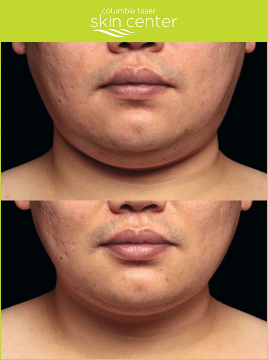 Double CHin Before and After Coolsculpting Treatments