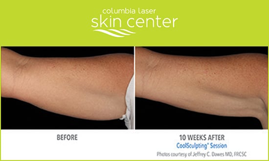 Coolsculpting Arm repair - available for Hood River, The Dalles and surrounding areas in Oregon and Washington at Columbia Laser Skin Center