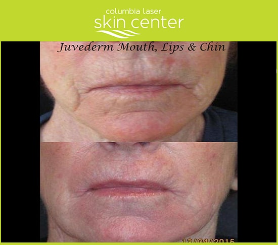 Juverderm for Mouth, Lips and Chin non-surgical face and neck treatments - available for Hood River, The Dalles and surrounding areas in Oregon and Washington at Columbia Laser Skin Center