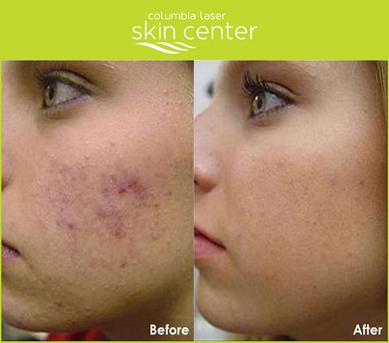 CLSC Acne Peel Before and After - available for Hood River, The Dalles and surrounding areas in Oregon and Washington at Columbia Laser Skin Center