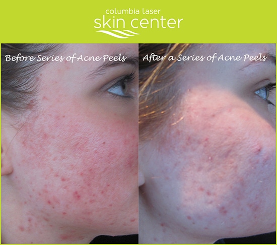 Acne Peels - Before and After - available for Hood River, The Dalles and surrounding areas in Oregon and Washington at Columbia Laser Skin Center