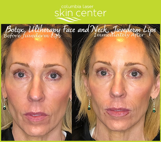Botox, Ultherapy for the face and neck, Juvederm for the lips