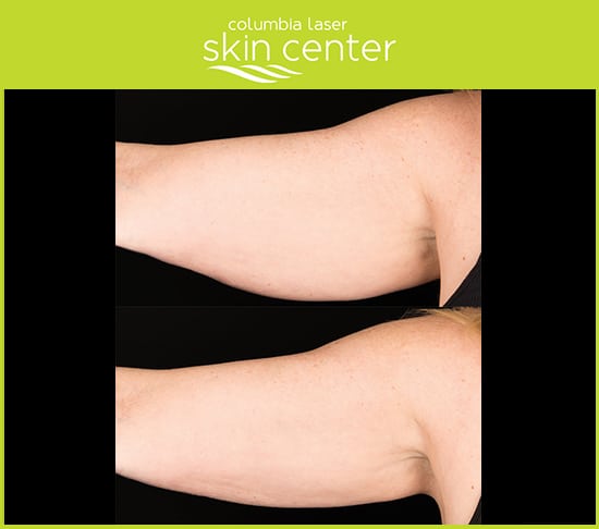 CLSC - Coolsculpting Arm repair - available for Hood River, The Dalles and surrounding areas in Oregon and Washington at Columbia Laser Skin Center