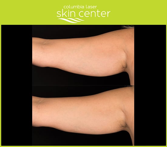 Coolsculpting at CLSC - Arm repair - available for Hood River, The Dalles and surrounding areas in Oregon and Washington at Columbia Laser Skin Center