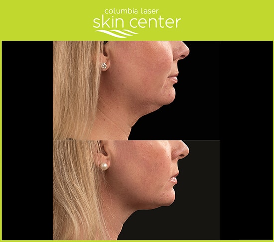 CoolSculpting at CLSC - Double Chin repair - available for Hood River, The Dalles and surrounding areas in Oregon and Washington at Columbia Laser Skin Center