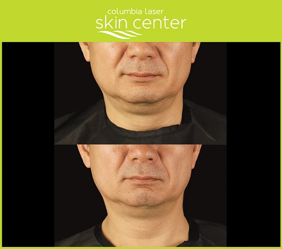 CoolSculpting Treatments for Double Chin repair - available for Hood River, The Dalles and surrounding areas in Oregon and Washington at Columbia Laser Skin Center