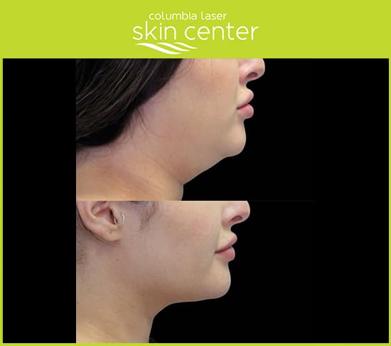 Double Chin repair at CLSC- available for Hood River, The Dalles and surrounding areas in Oregon and Washington at Columbia Laser Skin Center