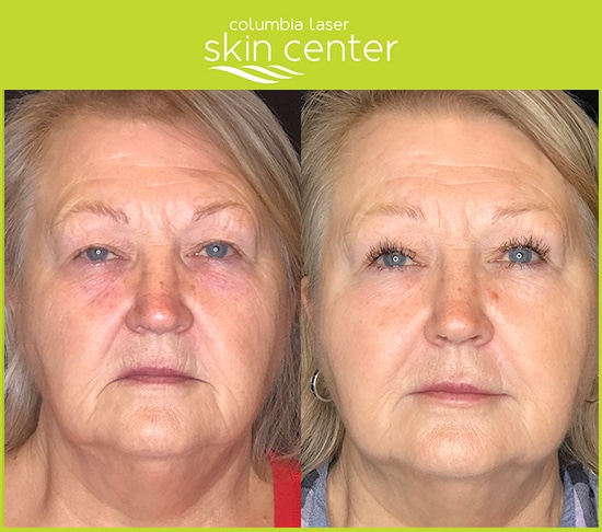 Fillers before and after - CoolSculpting, Botox, Voluma and Juvederm - available for Hood River, The Dalles and surrounding areas in Oregon and Washington at Columbia Laser Skin Center