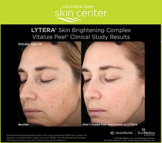 Lytera Skin Brightening and Vitalize Peel - available for Hood River, The Dalles and surrounding areas in Oregon and Washington at Columbia Laser Skin Center