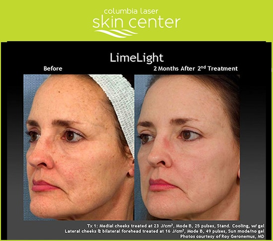 Lytera Skin Brightening - available for Hood River, The Dalles and surrounding areas in Oregon and Washington at Columbia Laser Skin Center