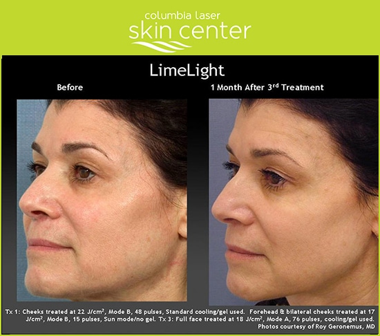 Limelight Before and After - available for Hood River, The Dalles and surrounding areas in Oregon and Washington at Columbia Laser Skin Center