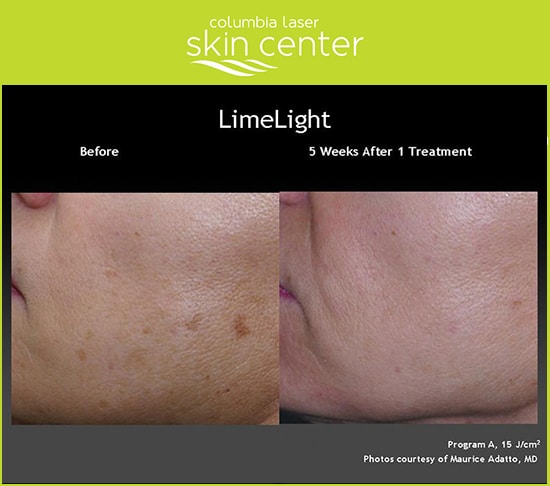 Limelight Treatment - available for Hood River, The Dalles and surrounding areas in Oregon and Washington at Columbia Laser Skin Center