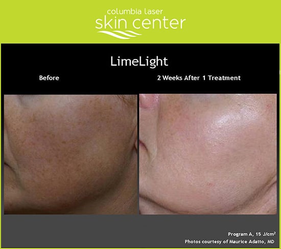 CLSC Limelight Treatment - available for Hood River, The Dalles and surrounding areas in Oregon and Washington at Columbia Laser Skin Center