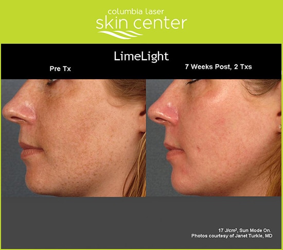 Limelight Facial Treatment - available for Hood River, The Dalles and surrounding areas in Oregon and Washington at Columbia Laser Skin Center