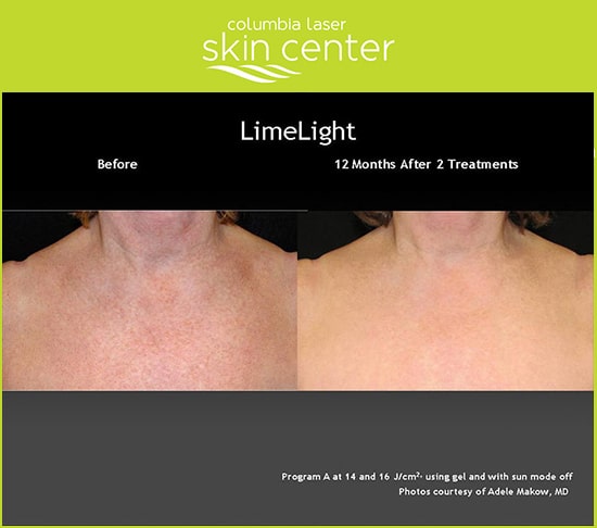 Limelight Decollage Treatment by Columbia Laser Skin Center