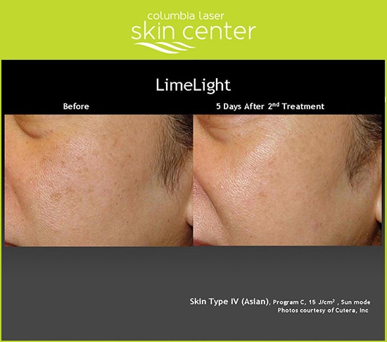 Limelight treatment on the cheeks by CLSC