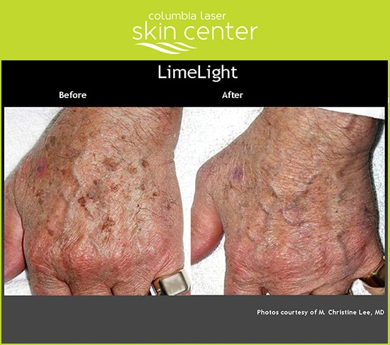 Limelight Hand Treatment - available for Hood River, The Dalles and surrounding areas in Oregon and Washington at Columbia Laser Skin Center