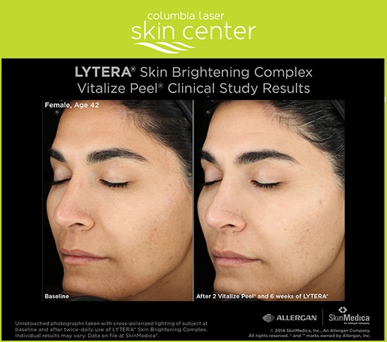 Lytera and Vitalize before and after photos