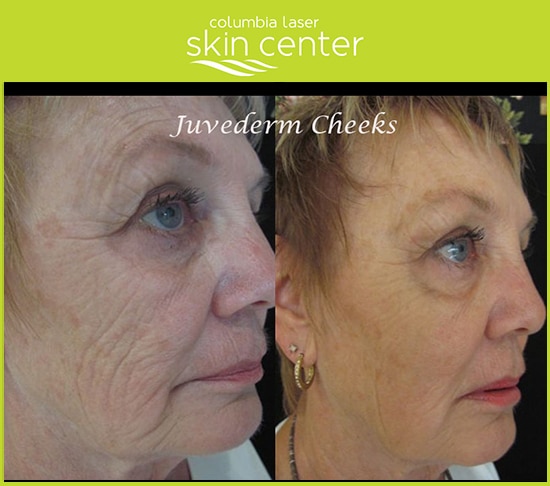 Juvederm Cheek Treatments - available for Hood River, The Dalles and surrounding areas in Oregon and Washington at Columbia Laser Skin Center